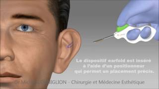 Earfold  une technique non chirurgicale pour les oreilles décollées  Dr Corniglion [upl. by Ardith319]