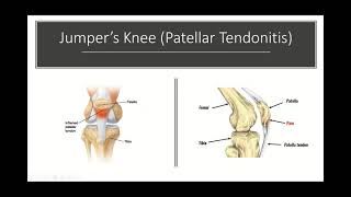 Jumpers Knee and Osgood Schlatters Disease in the Knee [upl. by Lillith]