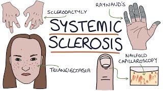 Systemic Sclerosis and Scleroderma Visual Explanation for Students [upl. by Labannah]