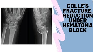 Distal radius colles fracture reduction and plaster application under haematoma block ortho vid 6 [upl. by Wye]