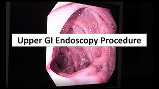 Upper GI Endoscopy Procedure in the ED [upl. by Yerak]