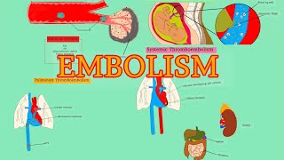 Pathology 18HDD 4  EMBOLISM  Pulmonary thromboembolism  Systemic thromboembolism AfSoomaali [upl. by Eiroj]