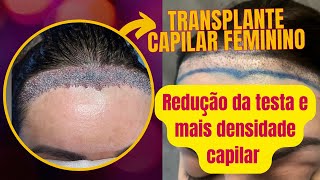 Fiz Transplante Capilar Feminino para redução de testa e densidade capilar Valores Como é feito [upl. by Barnard]