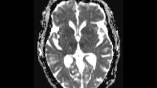 Basilar Tip Thrombosis top of the basilar syndrome [upl. by Ennovart]