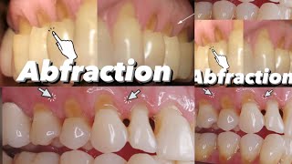 Dental Abfraction [upl. by Cummings]