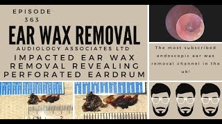 IMPACTED EAR WAX REMOVAL REVEALING PERFORATED EARDRUM EP363 [upl. by Yssac]