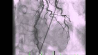 Takotsubo Cardiomyopathy  Angiogram of Left Coronary Artery [upl. by Hesketh]