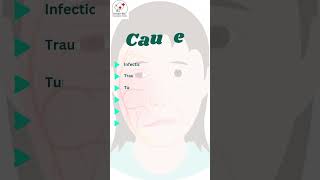 Know About Facial Nerve Palsy nerveloss facialnerveloss bellspalsy ghoshentfoundation ent [upl. by Jedd]