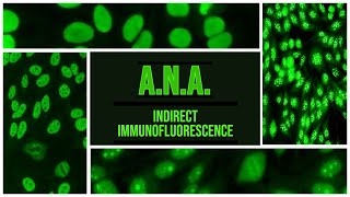 ANA  Antinuclear Antibody  IIF  SLE  Sjogren  RA  CREST [upl. by Yatnuahs]