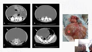 CAVIDAD PERITONEAL Y SUPRARRENALES EN TOMOGRAFÍA [upl. by Buttaro]