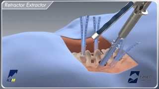 EVEREST® Minimally Invasive Surgical Technique Animation [upl. by Atinram]