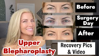 Upper Blepharoplasty Eyelid Surgery  Recovery Pics and Videos  Before amp Afters [upl. by Earas]