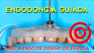 TUTORIAL ENDODONCIA GUIADA DIGITAL  CÓMO DISEÑAR LA FÉRULA PASO A PASO EN DIENTES CALCIFICADOS [upl. by Nillad]