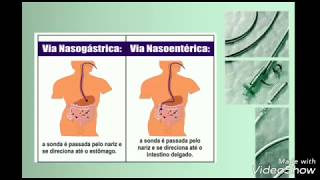 Passagem de SNE Sonda Nasoenteral  Sondagem Nasoenterica [upl. by Schonthal]