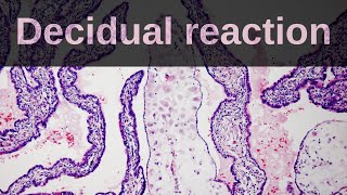 What is Decidual Reaction Pathology mini tutorial [upl. by Eldin]