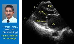 This echocardiogram was taken in parasternal long axis view What is the diagnosis [upl. by Eihtak]