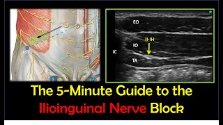 Ilioinguinal Nerve Block  A HowTo Guide [upl. by Nylzaj]