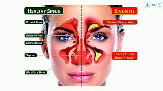 catarrh English  Medical terminology for medical students [upl. by Ettenor]