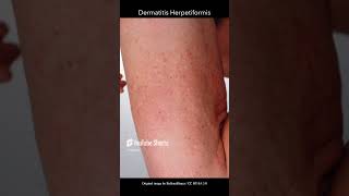 Dermatitis Herpetiformis [upl. by Norma]