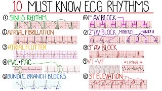 Most Common ECG Patterns You Should Know [upl. by Litnahc427]