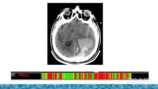 Multimodal Monitoring in Neurocritical Care [upl. by Sirtemed]