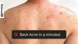 How To Get Rid Of Back Acne  What Habits Cause Bacne Tips amp Products ✨ [upl. by Yrrum]