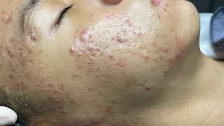 ACNE TREATMENT VU QUYNH MI  Perennial Blackheads On Boy Face 2024FULL [upl. by Arretal]