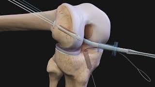 Arthrex ACL Reconstruction [upl. by Atnuahc662]