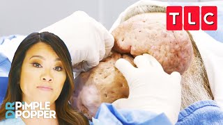 Dr Lee Treats The Largest Nasal Growths Shes Ever Seen  Dr Pimple Popper  TLC [upl. by O'Grady]