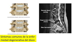 Síntomas comunes de la enfermedad degenerativa del disco [upl. by Northington]