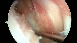 Knee Arthroscopy  Gout [upl. by Tatman]