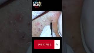 how to remove the blackheads pimple [upl. by Anana26]