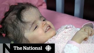 Toddler survives drastic skull reconstruction surgery [upl. by Otilrac]