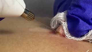 REMOVING GIANT WART WITH PLASMA JET [upl. by Aehtorod]