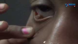 Stones coming out from a girls eyes in East Godavari district [upl. by Hime878]