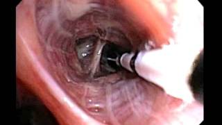 Bronchial Thermoplasty Improved Asthma Control for your Patients [upl. by Lillian403]