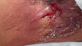 Acne Treatment Huong Da Nang  2024 blackheads 704 squeeze pimples on the back of your neck [upl. by Aekal]