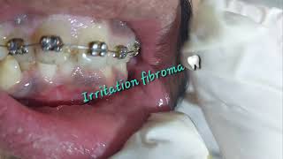 Oral benign asymptomatic prolonged irritation fibroma caused by cheek biting rubbing from teeth [upl. by Lanuk230]