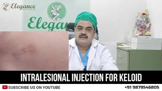 Intralesional Injection For Keloid Treatment By Dr Ashutosh Shah Elegance Clinic Surat Mumbai [upl. by Hooker]