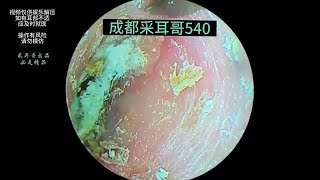 Treating moldy cerumen on the ear canal and eardrum ｜ 540 [upl. by Adehsar]