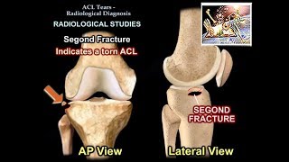 ACL Tears Radiological Evaluation  Everything You Need To Know  Dr Nabil Ebraheim [upl. by Alahsal5]