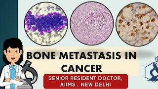 Bone metastasis in cancer Symptoms and diagnosis  A casebased study [upl. by Ellwood480]