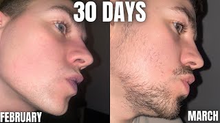 INSANE Beard growth in only 30 Days using MINOXIDIL and DERMA ROLLING [upl. by Sparke]