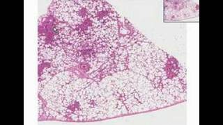 Histopathology LungBronchopneumonia [upl. by Elbag]