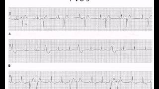 Easy EKG Premature Ventricular Contractions and Atrial Fibrillation [upl. by Yrrehs466]