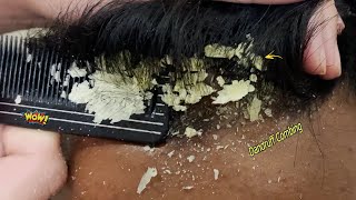 Satisfying Itchy Scalp Treatment 860  Scratching Dandruff [upl. by Zipah314]