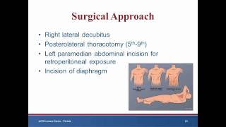 Keynote Lecture Thoracoabdominal aortic aneurysm [upl. by Irisa868]