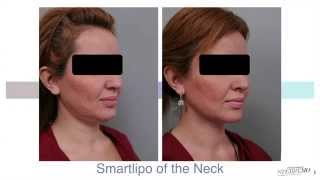 Double Chin Liposuction With Smartlipo™  Dr Sterry Explains [upl. by Veronique]