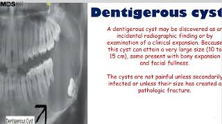 5 1 Dentigerous Cyst [upl. by Asial707]