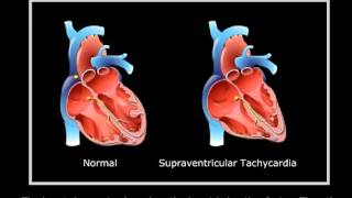 Supraventricular tachycardia [upl. by Koetke]